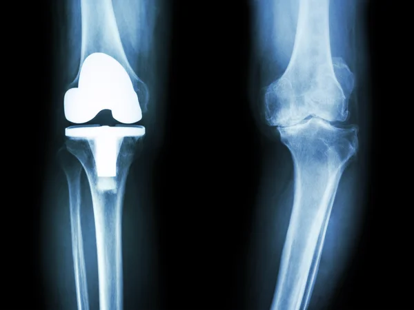 Film x-ray knee of osteoarthritis knee patient and artificial joint — Stock Photo, Image