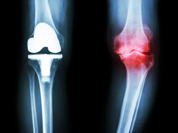 Film x-ray knee of osteoarthritis knee patient and artificial joint — Stock Photo, Image
