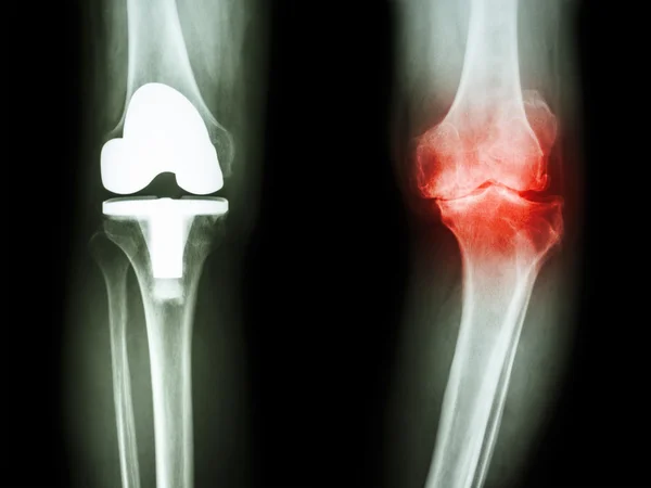 Pellicola ginocchio a raggi X di osteoartrite paziente ginocchio e articolazione artificiale — Foto Stock