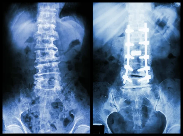 "Spondylose "(linkes Bild) wurde der Patient operiert und interniert. (Bild rechts)) — Stockfoto