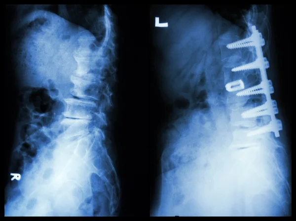 "Spondylosis "(lewy obraz), pacjent był obsługiwany i wewnętrzne stałe. (Prawy obraz) w Starzec — Zdjęcie stockowe