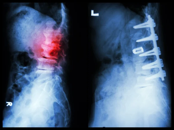 "Spondilosis" (Sol görüntü) , Hasta ameliyat edildi ve dahili sabit. (Sağ görüntü) yaşlı adam — Stok fotoğraf