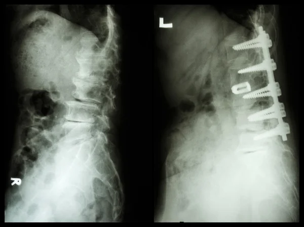 "脊椎症」(左の画像)、患者を手術し、内部固定した。(右画像)老人「脊椎症」(左の画像)で、患者を手術し、内部固定した。(右の画像) 老人 — ストック写真