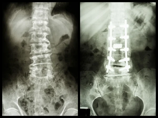 "Spondilosis" (Sol görüntü) , Hasta ameliyat edildi ve dahili sabit. (Doğru görüntü) — Stok fotoğraf