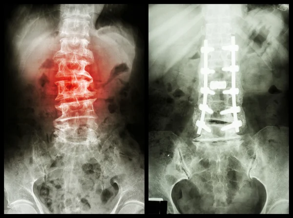 "Spondilosis" (Sol görüntü) , Hasta ameliyat edildi ve dahili sabit. (Doğru görüntü) — Stok fotoğraf