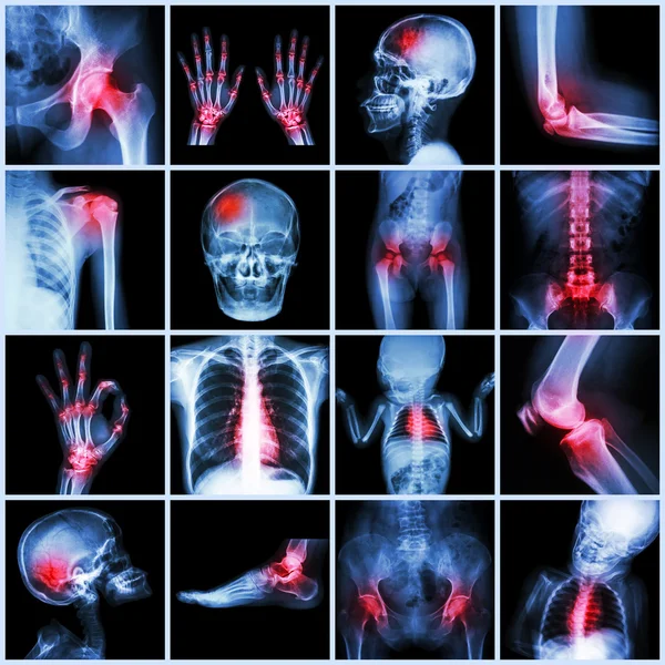 Sammlung Röntgen mehrerer Teile von Mensch und Arthritis, multiple Krankheiten (Gicht, Rheumatoide, angeborene Herzkrankheiten, Schlaganfall) — Stockfoto