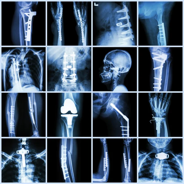 Kolekce rentgenové ortopedické chirurgie (více částí lidského, operačního a interního upevnění pomocí plát & šroubu ) — Stock fotografie