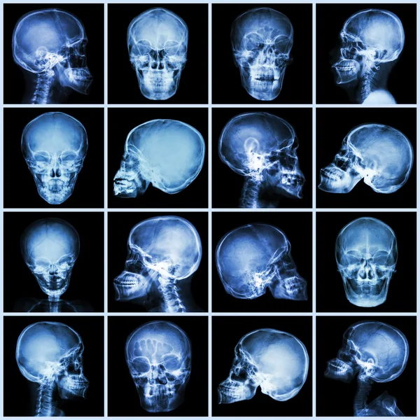 Samling Röntga skallen (asiatiska människor) — Stockfoto