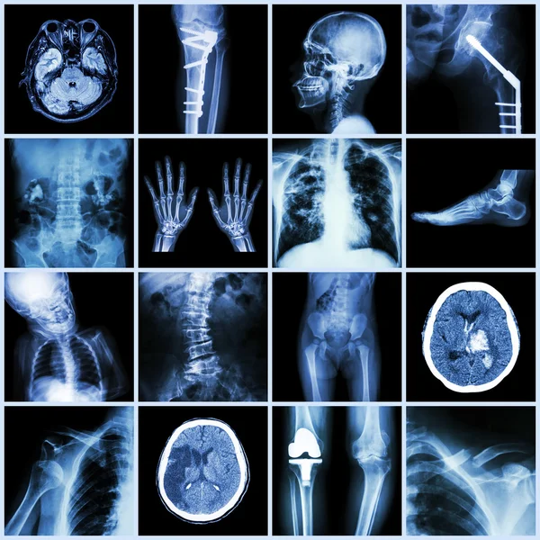 Röntgen-Multiple-Part des Menschen, multiple Krankheiten, orthopädische, chirurgische (Schlaganfall, Knochenbruch, orthopädische Operation, Nierenstein, Arthritis, Gicht, Lungentuberkulose, Herzkrankheiten, Skoliose, usw.)) — Stockfoto