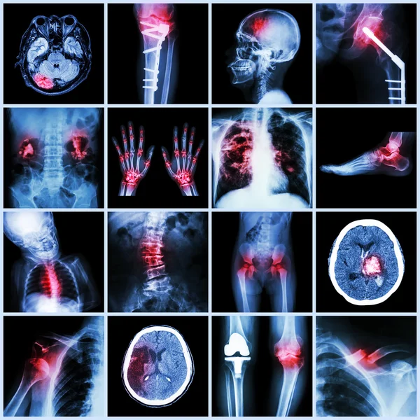 Conjunto de rayos X parte múltiple de humanos, enfermedad múltiple, ortopédica, cirugía (accidente cerebrovascular, fractura ósea, operación ortopédica, cálculos renales, artritis, gota, tuberculosis pulmonar, enfermedad cardíaca, escoliosis, etc. ) —  Fotos de Stock