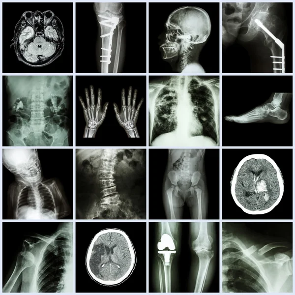 Serie di raggi X parte multipla di umano, malattia multipla, ortopedico, chirurgia (ictus, frattura ossea, operazione ortopedica, calcoli renali, artrite, gotta, tubercolosi polmonare, malattie cardiache, scoliosi, ecc ) — Foto Stock