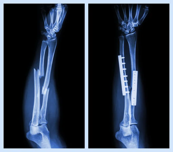 Och bryter båda ben av underarmen. Det var i drift och inre fast med plattan och skruv (vänstra bilden: innan operation, höger bild: efter operation) — Stockfoto