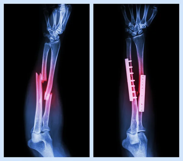 Перелом обох кісток передпліччя. Він керувався внутрішньою фіксованою пластиною та гвинтом (ліворуч зображення: перед операцією, праворуч зображення: після операції ) — стокове фото