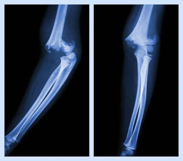 Fracture elbow (Left image : side position , Right image : front position) — Stock Photo, Image