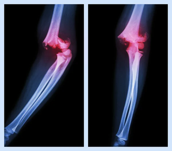 Fracture elbow (Left image : side position , Right image : front position) — Stock Photo, Image