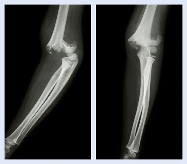 Codo de fractura (imagen izquierda: posición lateral, imagen derecha: posición frontal ) — Foto de Stock