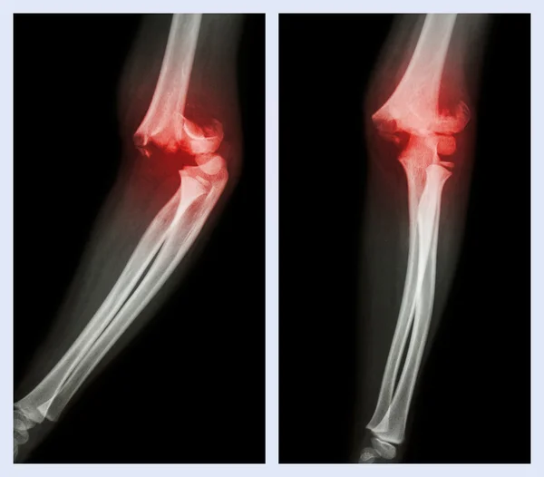 Codo de fractura (imagen izquierda: posición lateral, imagen derecha: posición frontal ) —  Fotos de Stock