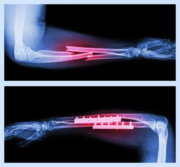 Image supérieure : Fracture ulnaire et radius (os de l'avant-bras), Image inférieure : Il a été actionné et fixé à l'intérieur avec une plaque et une vis — Photo