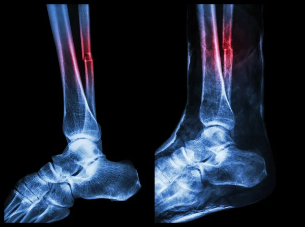 Left image : Fracture shaft of fibula (calf bone)  ,  Right image : It was splinted with plaster cast — Stock Photo, Image