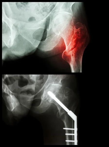 Fractura intertrocantérica del fémur izquierdo (fractura del hueso del muslo). Fue operado e insertado clavo intramedular . — Foto de Stock