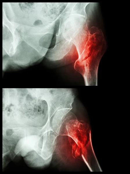 Cabeza fracturada de fémur (hueso del muslo) (fractura intertrocantérica) (2 posiciones ) — Foto de Stock