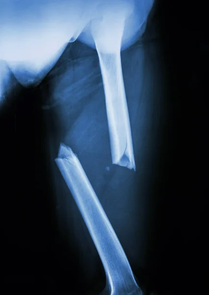 Руйнування стегнової кістки — стокове фото
