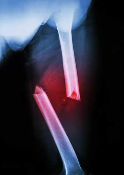 fracture femur