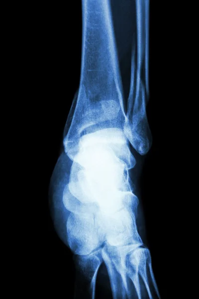 Film X-ray ankle menunjukkan fraktur distal tibia dan fibula (tulang kaki ) — Stok Foto