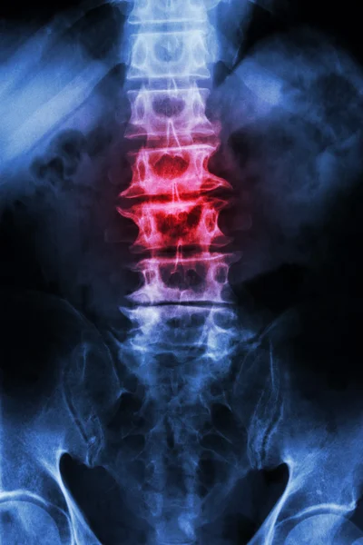 ""Спондильоз" плівка рентгенівського хребта L-S (світлова сакума) старого старого пацієнта та запалення в хребті — стокове фото