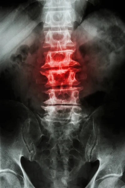 "Espondilose "filme X-ray L-S coluna vertebral (lombar-sacro) de paciente idoso e inflamação na coluna vertebral — Fotografia de Stock