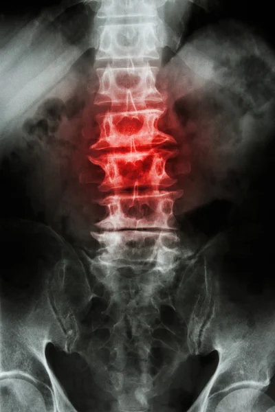 "Espondilosis "radiografía de la película L-S espina dorsal (sacro lumbar) del paciente anciano y la inflamación en la columna vertebral — Foto de Stock