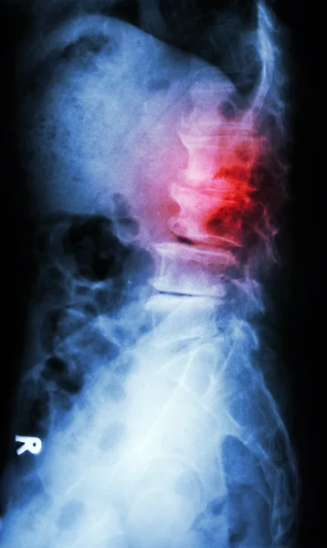 "Spondylolisthesis" — Stock Photo, Image