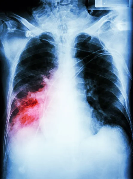 肺炎合并呼吸衰竭 — 图库照片