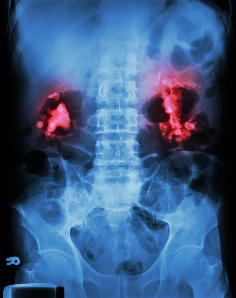 Bilaterale renale calculi (staghorn) — Stockfoto