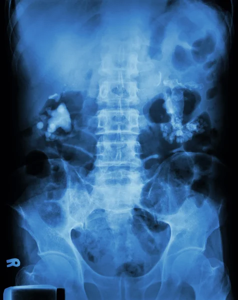 Bilateral renal calculi(staghorn) — Stock Photo, Image