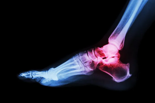 Artrite na articulação do tornozelo (gota, artrite reumatoide ) — Fotografia de Stock