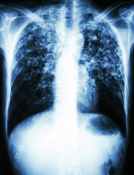 Mycobacterium tuberculosis infection (Pulmonary Tuberculosis) — Stock Photo, Image