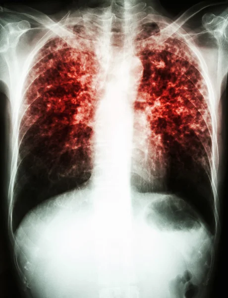 Mycobacterium tuberculosis infection (tuberculose pulmonaire ) — Photo