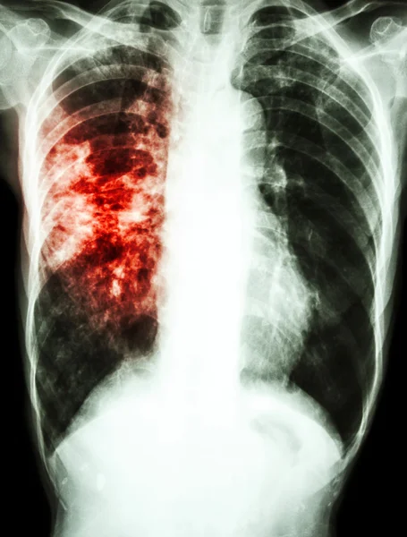 Infección por Mycobacterium tuberculosis (tuberculosis pulmonar) ) — Foto de Stock