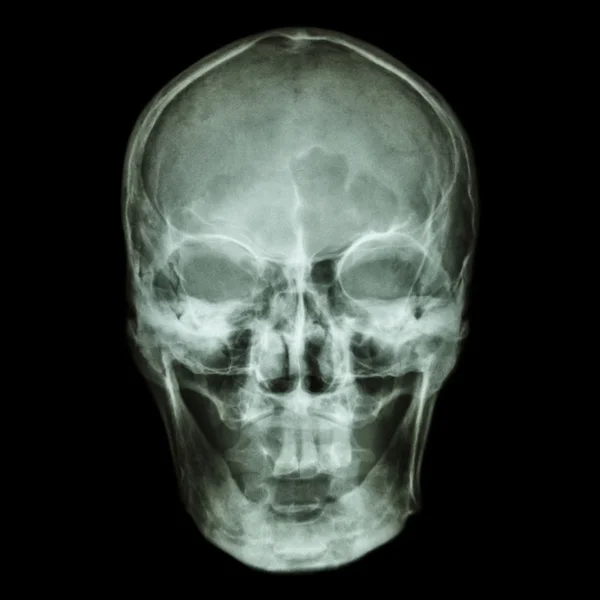 Crânio de raios-X (Asiático ) — Fotografia de Stock