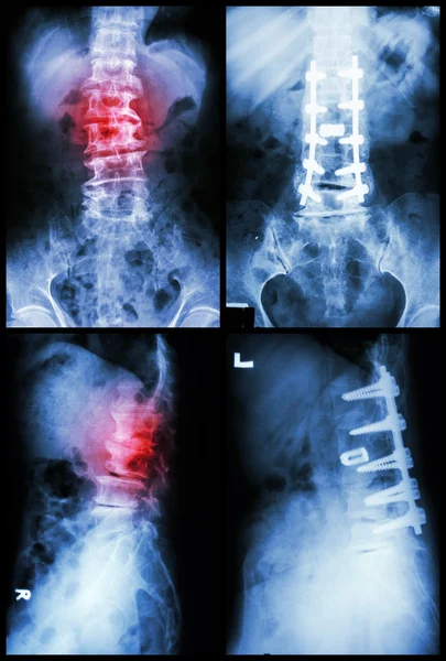 "Espondilose e Espondilolistese "Foi operada e fixada internamente na coluna vertebral (Imagem esquerda: pré-operada) (Imagem direita: pós-operada ) — Fotografia de Stock