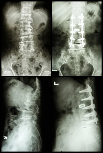 "脊椎症と脊椎関節症」脊椎で内部固定を行った(左画像:手術前)(右画像:手術後)) — ストック写真