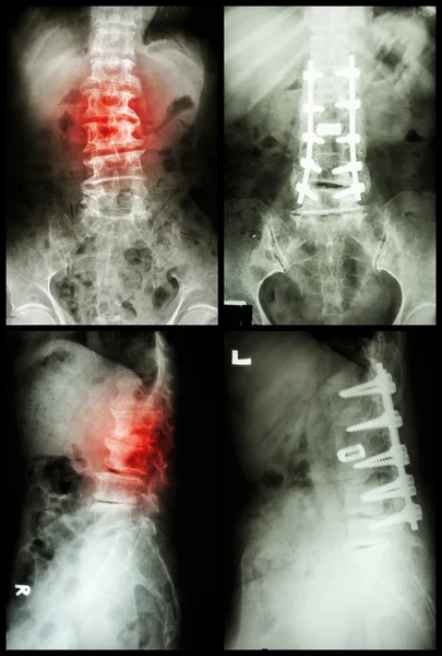 "Espondilose e Espondilolistese "Foi operada e fixada internamente na coluna vertebral (Imagem esquerda: pré-operada) (Imagem direita: pós-operada ) — Fotografia de Stock