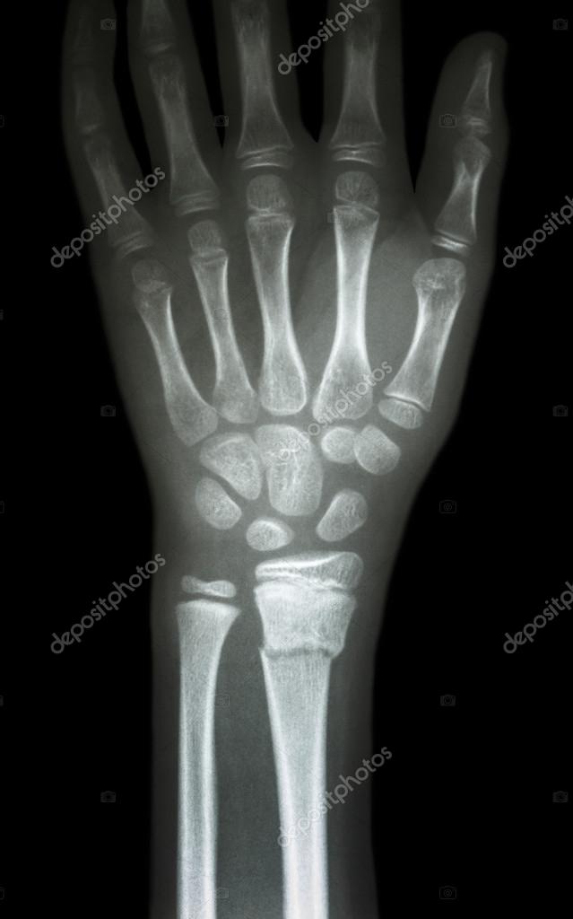 Fracture distal radius (forearm's bone) ⬇ Stock Photo, Image by © stockdevil_666 61371895
