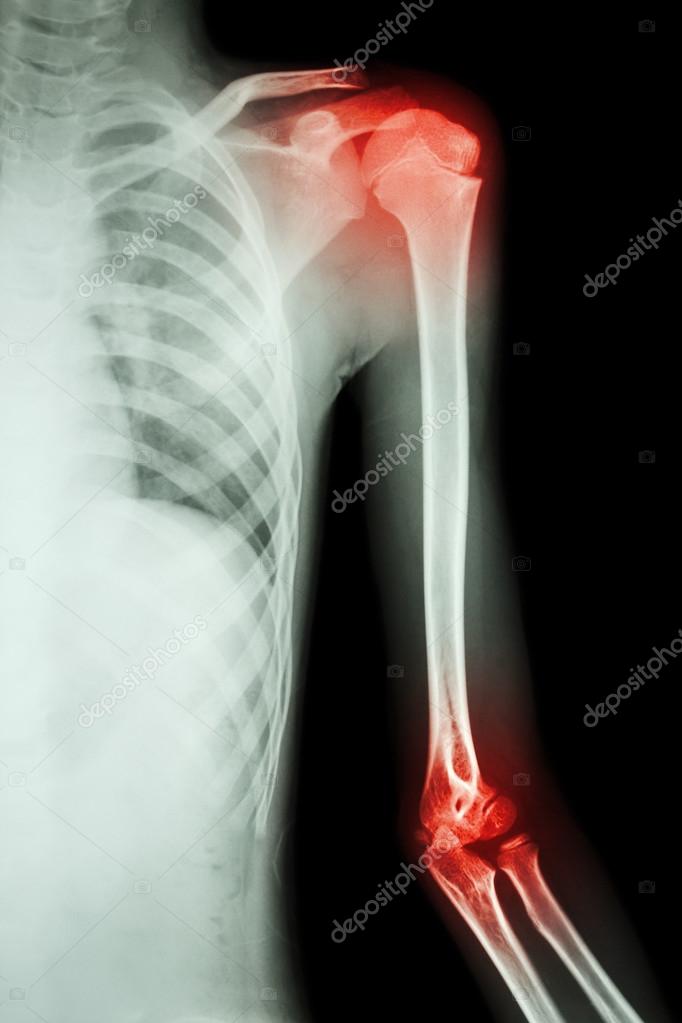 Left shoulder x ray anatomy Film xray left shoulder and arthritis at