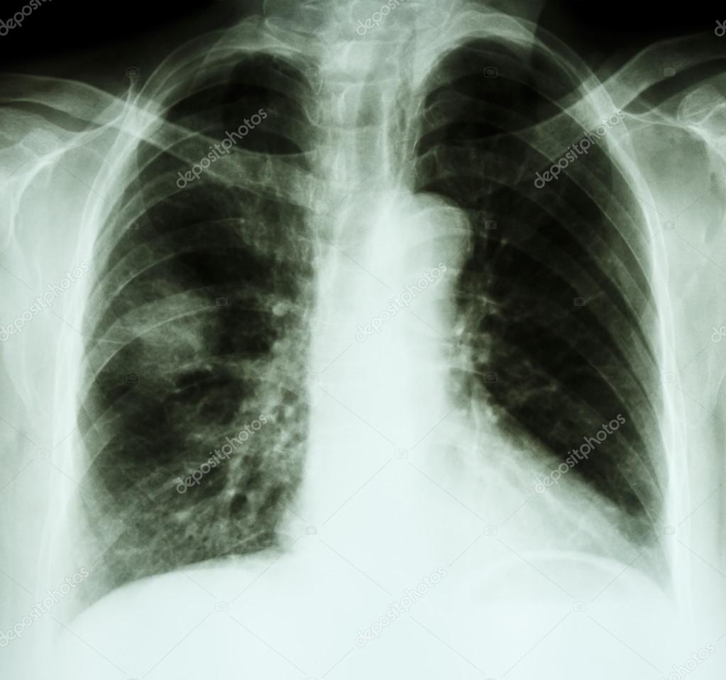 X-ray chest of lung cancer patient