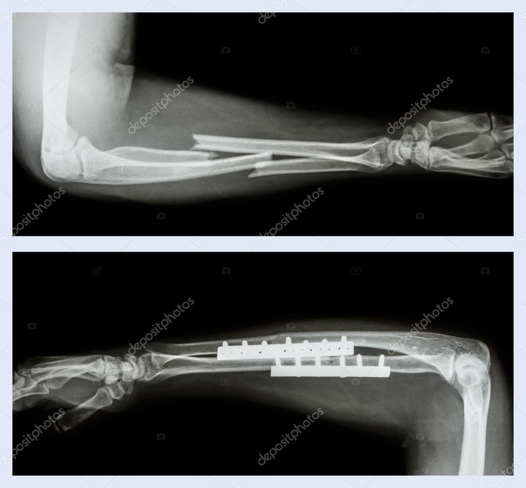 Upper image : Fracture ulnar and radius (Forearm bone) , Lower image : It was operated and internal fixed with plate and screw