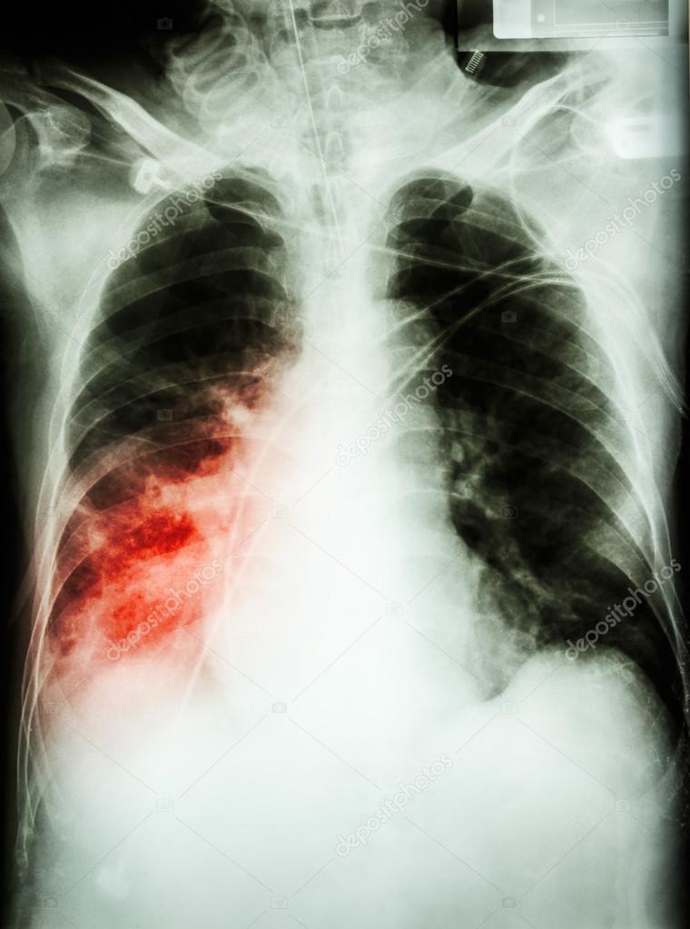 Pneumonia with respiratory failure