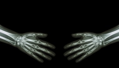 El sıkışın. Normal insan eli (boş alanı üst tarafındaki x-ışını )