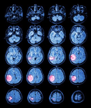 MRI beyin: beyin tümörü, sağ parietal LOB